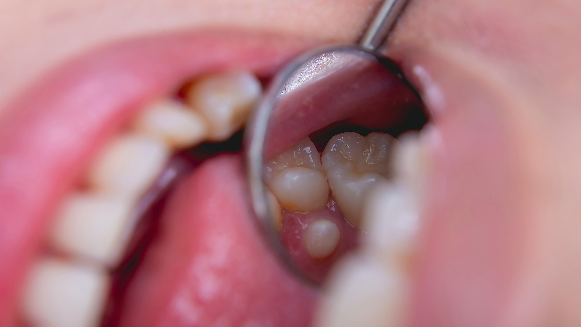 supernumerary teeth in kids