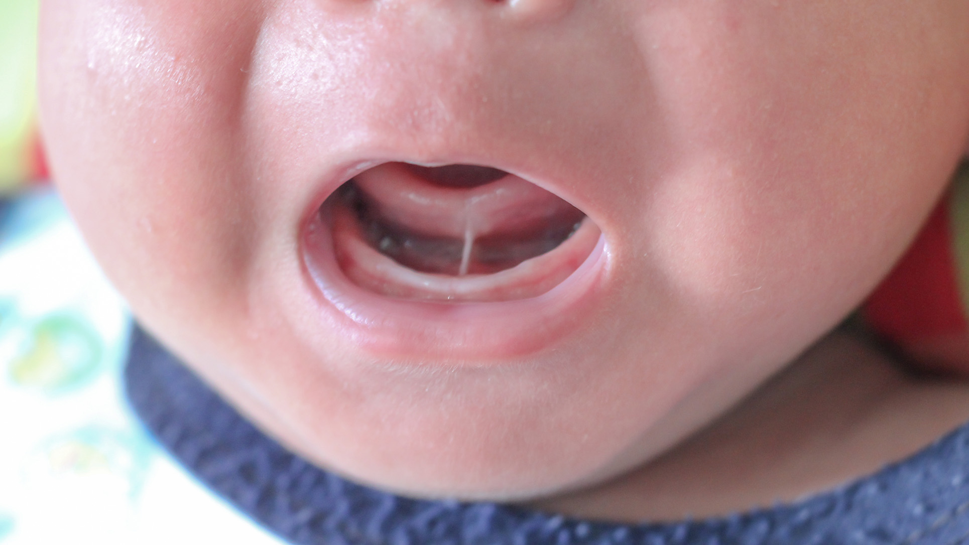 Why Tongue Ties Matter