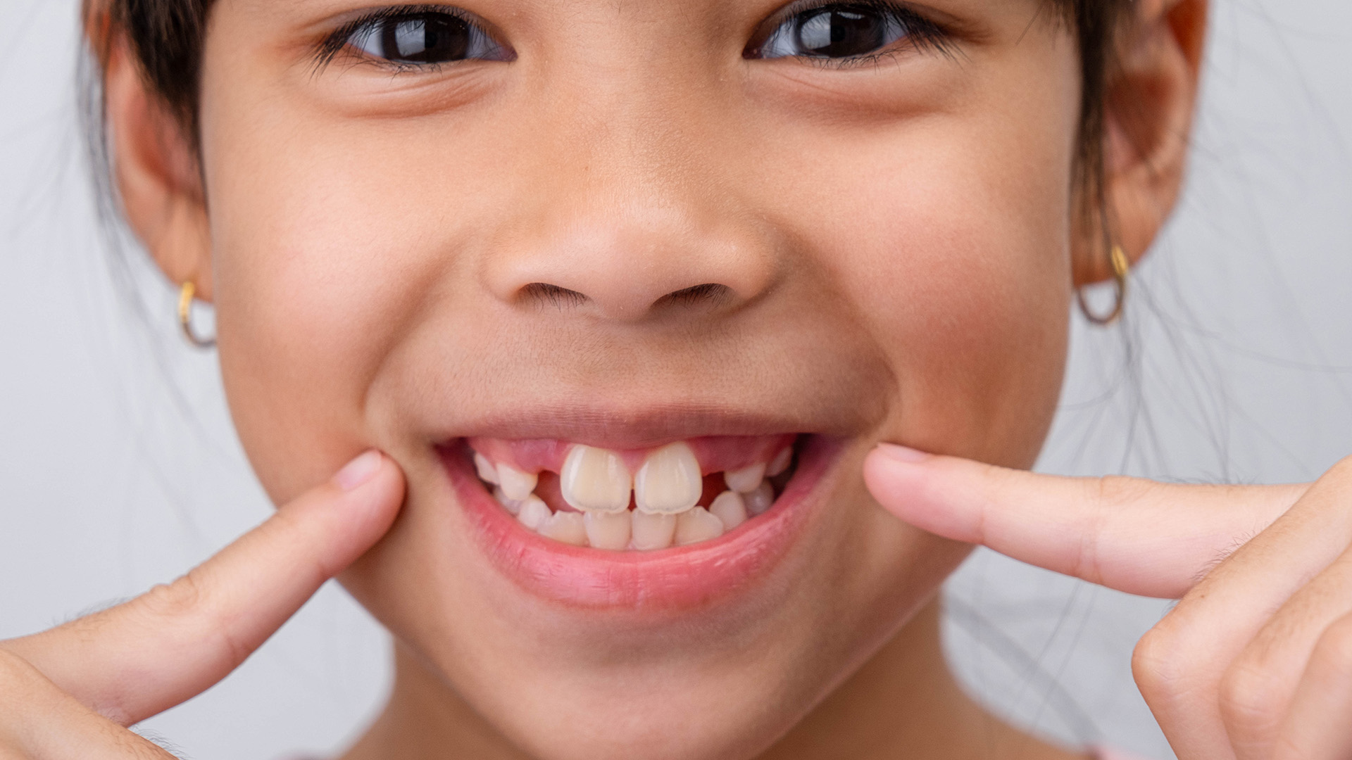 Why Your Child's New Adult Teeth Look Too Big: What Parents Should Know